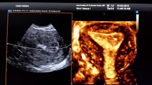 3-D uterine cavity