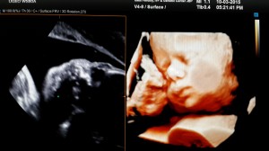 3-D image of an IVF fetus